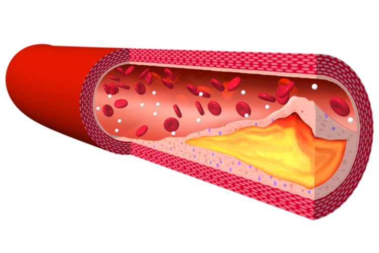 脂質異常症イメージ